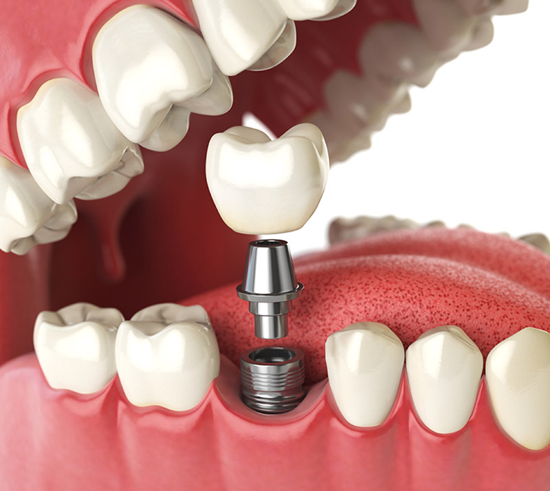 dental implants in Cambie