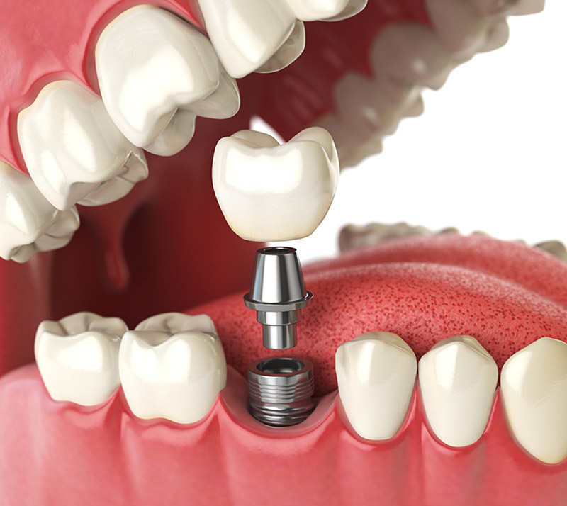 Full Mouth Dental Implants Wyoming MI