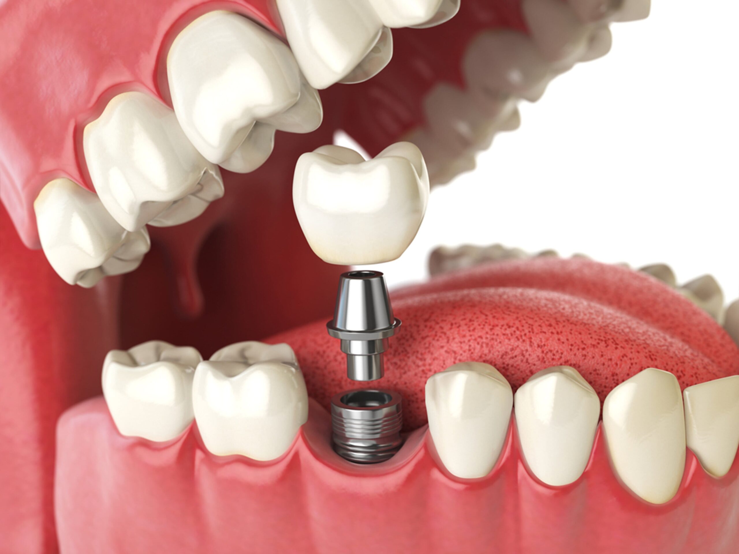 tips-for-dental-implants