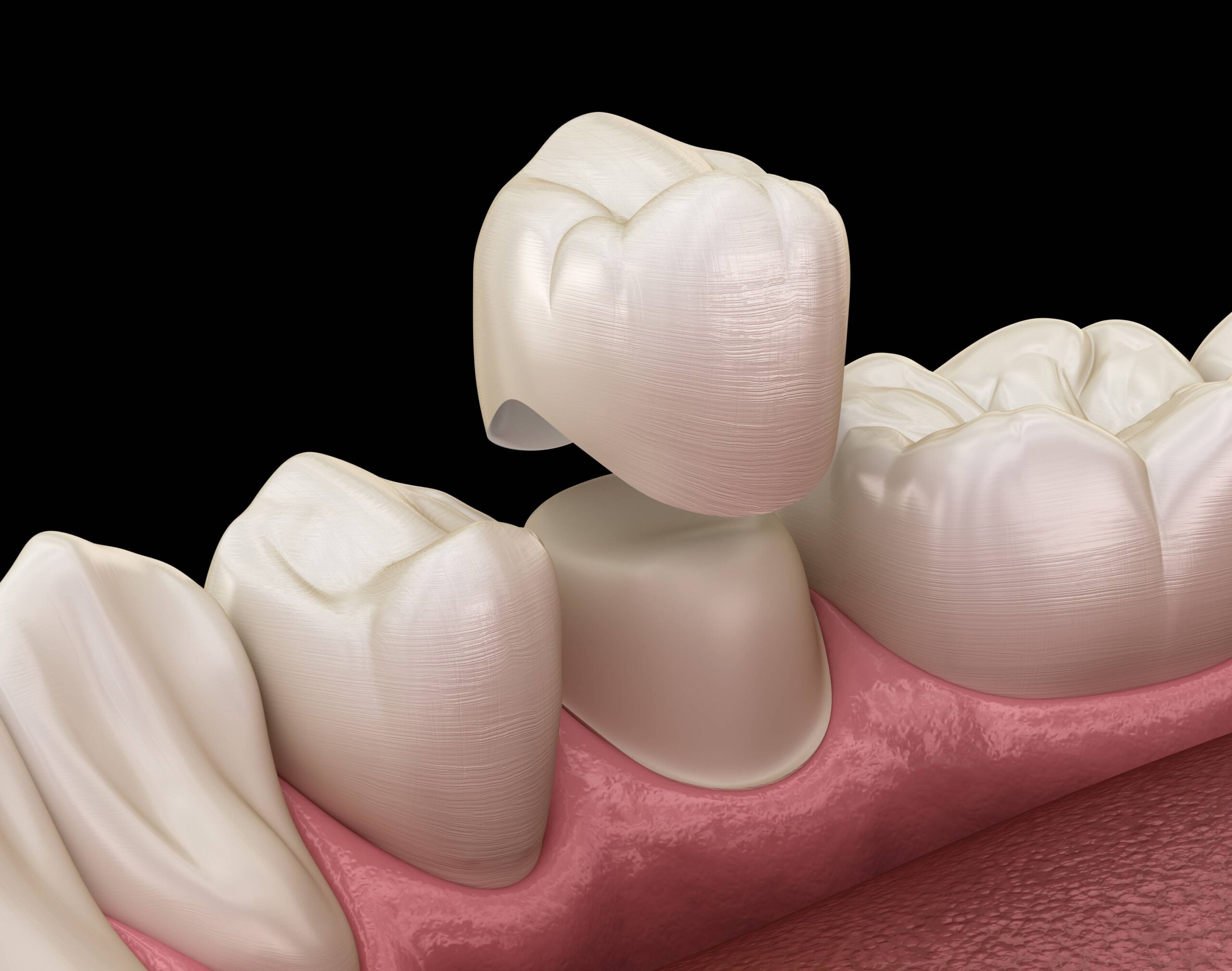 Understanding the Need for Dental Crowns