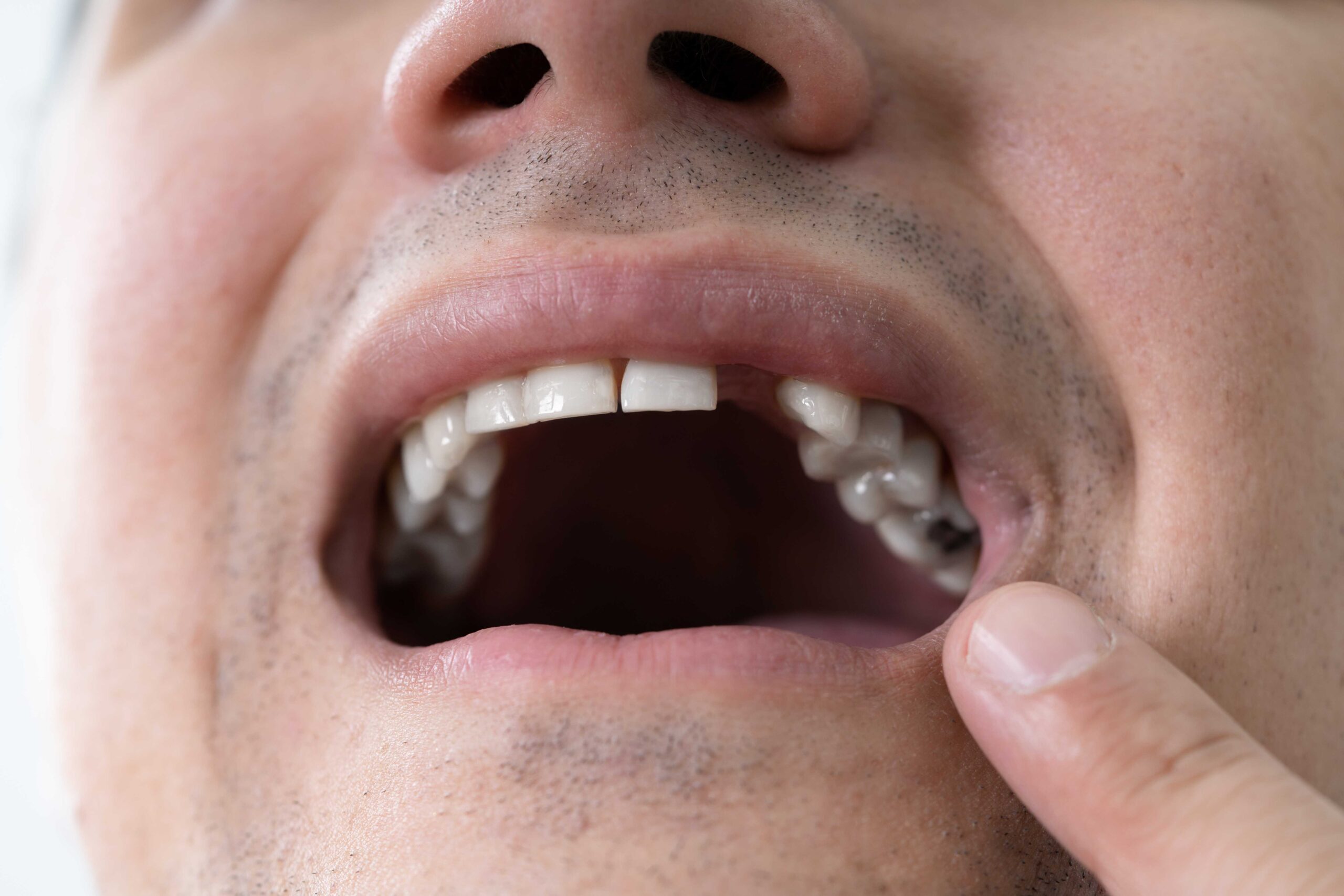 What is Tooth Extraction and When is it Necessary
