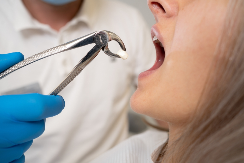 simple vs surgical tooth extractions