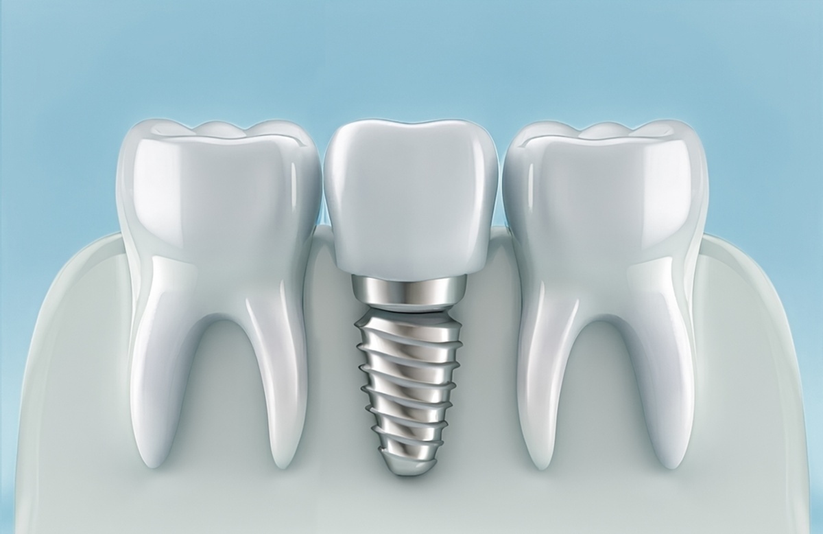 dental implants near vancouver