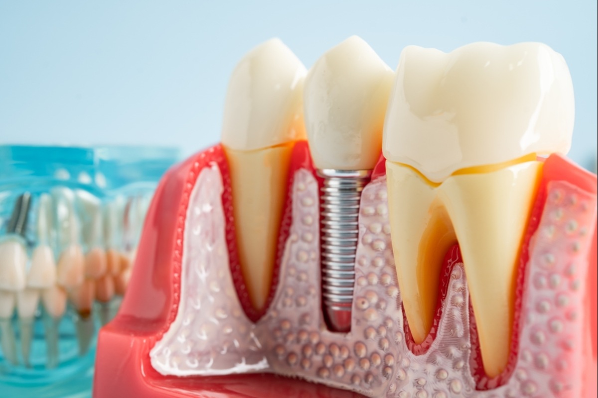 dental implant in vancouver
