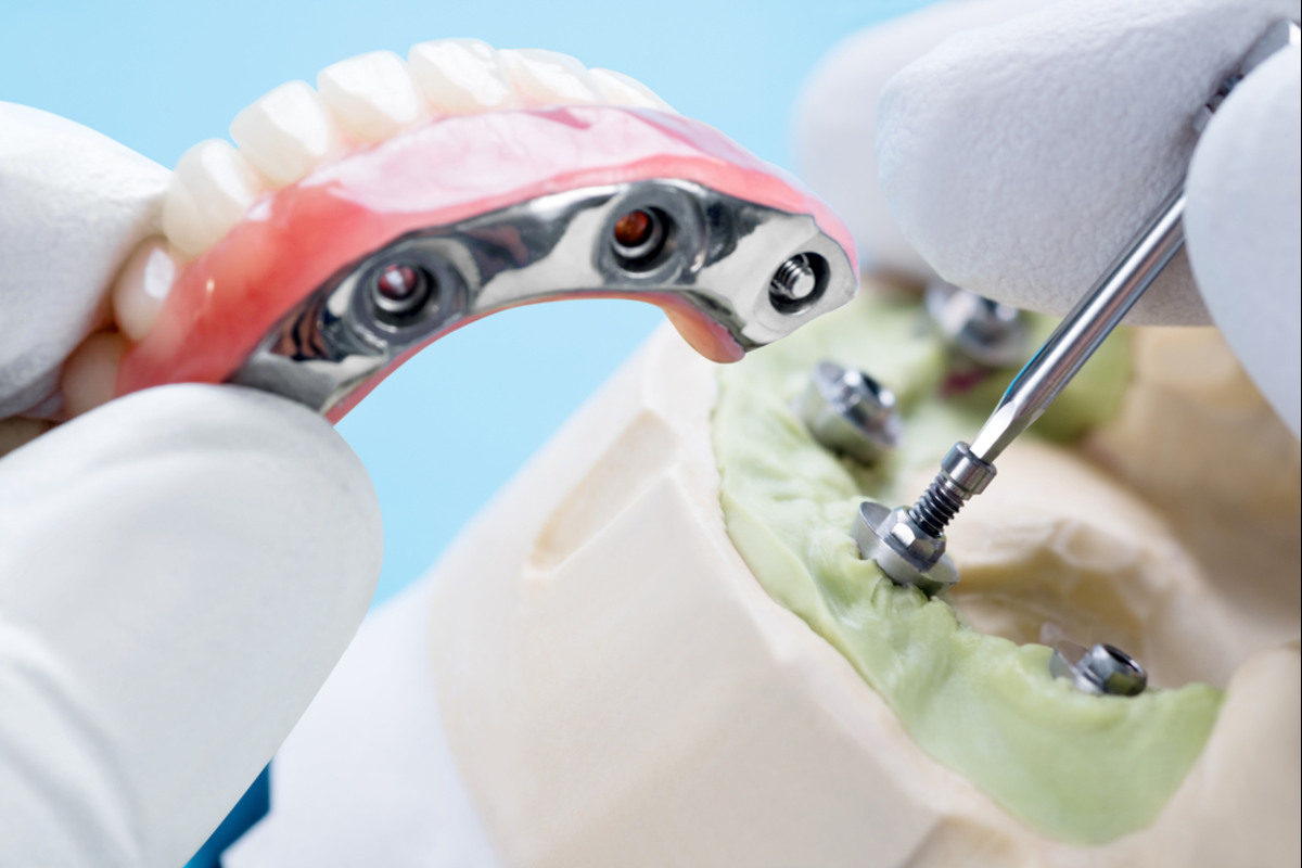 dental implant in vancouver