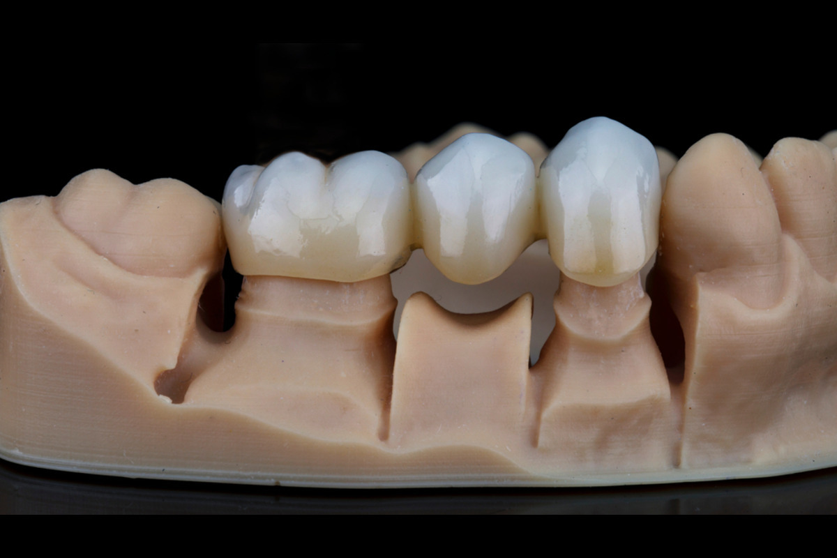 dental bridge in vancouver