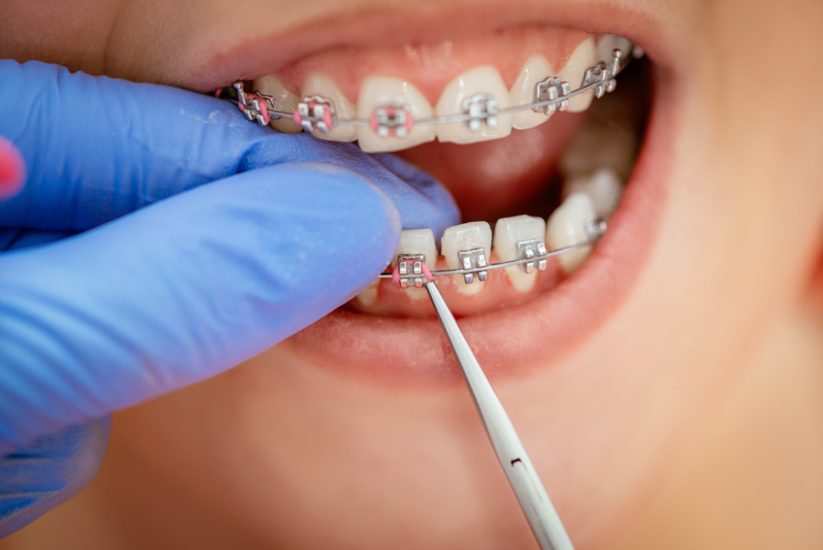 orthodontics in vancouver